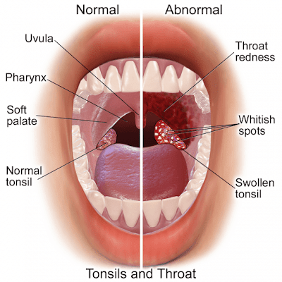 kecutkan bengkak tonsil, tonsil bengkak, punca tonsil bengkak, rawatan tonsil bengkak, cara kecutkan tonsil bengkak