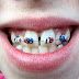 Top 4 cách chữa răng cửa bị hở