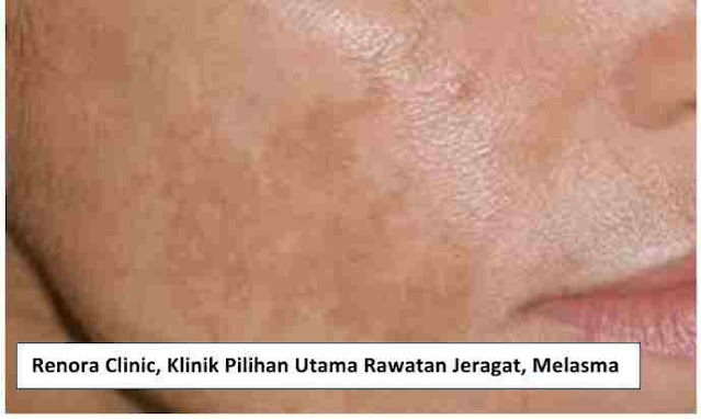 Renora Clinic,Klinik rawatan jeragat melasma, masalah jerawat,jeragat atau masalah kulit dapatkan rawatan di RENORA CLINIC,Renora Clinic berdaftar KKM