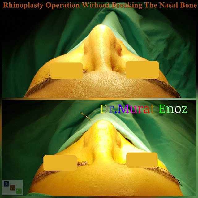 Nose job without bone broken,Rhinoplasty Without Breaking The Nasal Bone in Istanbul,