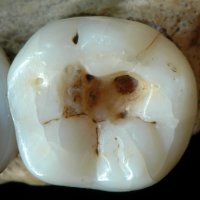 Oldest Dentistry Found in 14,000-Year-Old Tooth