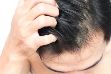 28 Cara Menghilangkan Kutu Rambut  dan Telurnya Metode 