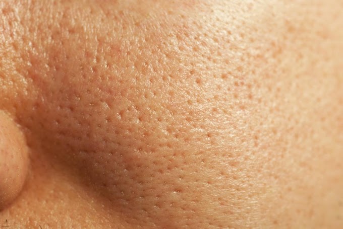  How to get rid of large pores-(खुले हुए रोम छिद्रो को कैसे ठीक करे )