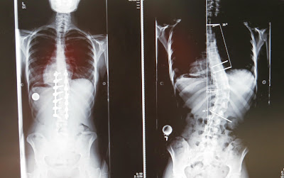 Scoliosis Story: Before and After Scoliosis Surgery thehollypaige.blogspot.com