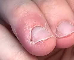 Nail Fungus Symptoms and Causes. How To Treat.