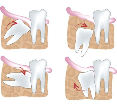 Cần làm gì khi răng khôn không mọc hết?