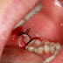 Cách xử lý mọc răng khôn bị chảy máu