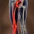 Physiotherapy dan Sciatica serta rawatan