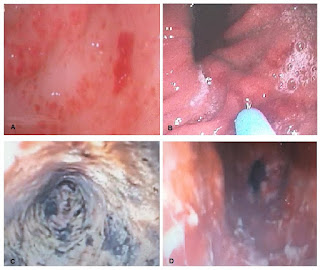 Fig 1: Causes of upper GIT bleeding in mechanically ventilated patients A: gastric ulcer B: Portal hypertensive gastropathy C: Black esophagus with a blackish necrotic surface. D: candida esophagitis with whitish membranes and superficial ulcers.