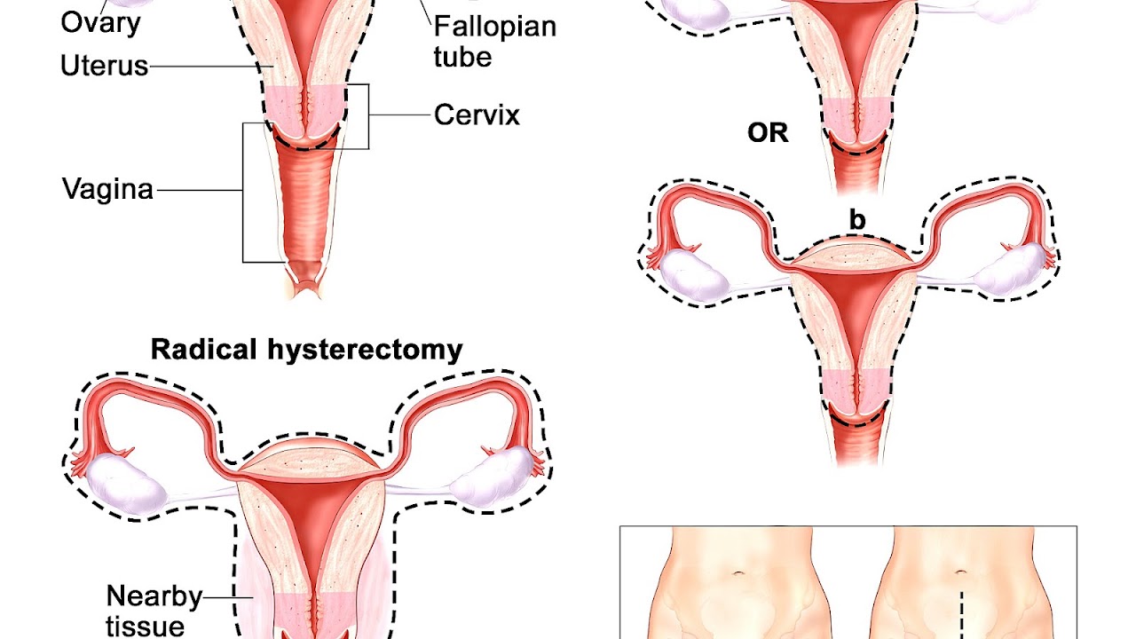 Side Effects Of Partial Hysterectomy