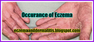 Occurance of Eczema