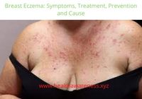 Breast Eczema