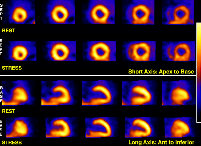 Nuclear Cardiology Case