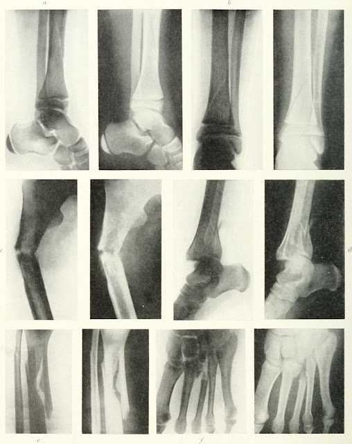 Diagnosis of open bone fracture