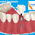 Perfect dental implants to augment your smile