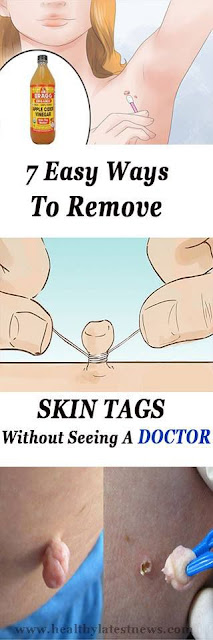 7 Easy Ways To Remove Skin Tags Without Seeing A Doctor