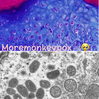 Monkeypox virus symptoms and treatment.