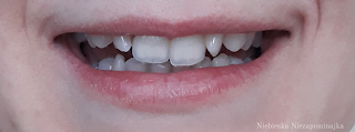 Efekt wybielania zębów z Dr. Martin Schwarz