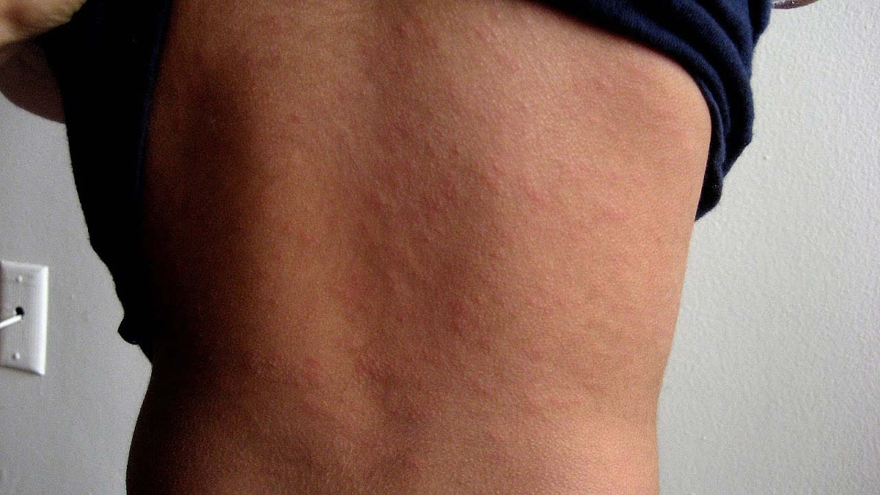 Allergic Reaction Side Effects