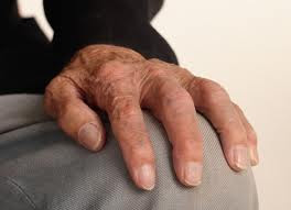 Que es la Artritis Reumatoide