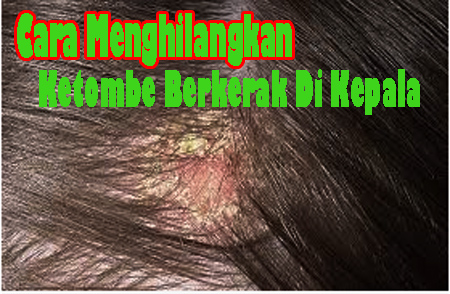 Cara Menghilangkan Ketombe Berkerak Di Kepala