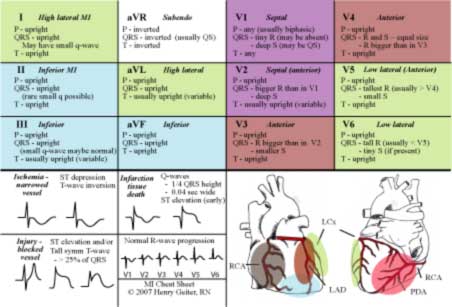 Unduh 570 Gambar Ekg Jantung Koroner  HD