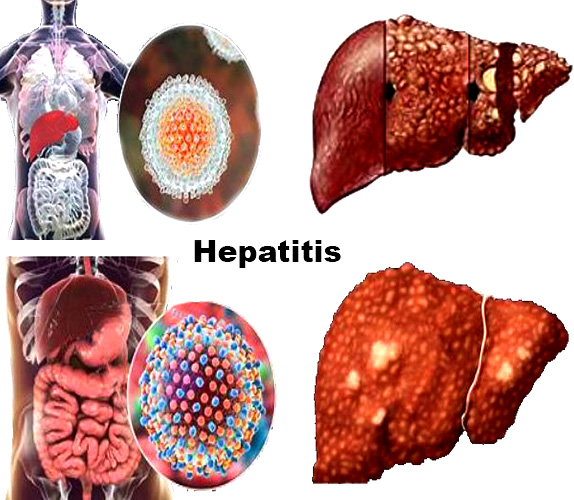 Hepatitis.