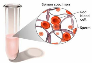 Penjelasan Darah dalam Semen Sperma (Hematospermia/hemospermia)