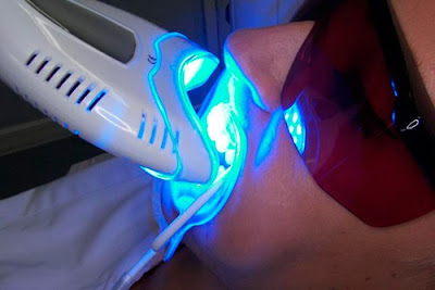 Tìm hiểu về công nghệ tẩy trắng răng bằng đèn laser 2