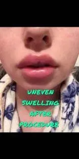 Lip Filler Swelling Stages Photos