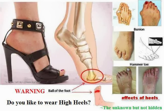 few health issues related to wearing high-heel shoes are; bunions ...