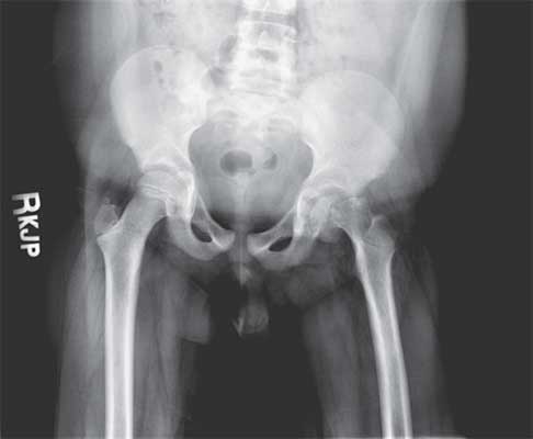 AP radiograph of the pelvis