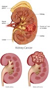 Kidney Tumor - Symptoms and Cure