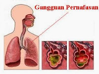 Gangguan/Penyakit Pada Alat/Organ Pernapasan Manusia Lengkap Dengan Penyebabnya