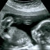 Tepatkah Imbasan Ultrasound Dalam Menentukan Jantina Bayi ??