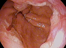 esophagus-cancer-treatment