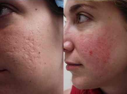 Free For Health: Acne Scar Treatment With Laser