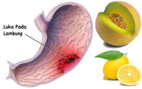 Ampuh Mengatasi Vertigo, Maag Akut, Migrain, Asam Urat Dengan Kombinasi Melon Dan Lemon