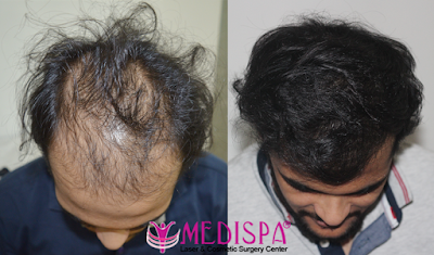 best hair transplant result