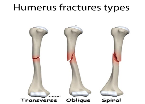 Humerus fractures types