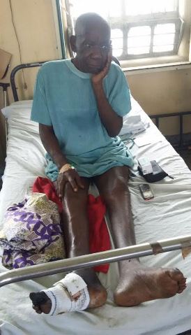 Photos: Veteran Actor, Tunde Alabi's foot finally amputated following complications from Diabetes, has no home to return to 