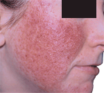 rosacea 3