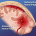 Εγκεφαλική αιμορραγία από... Ανεύρυσμα– «Κεραυνός εν αιθρία»