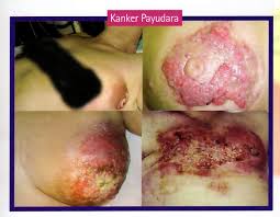 Obat Alami Kanker Payudara Murah