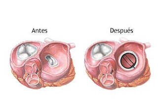 estenosis