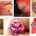 Resep Obat Wasir Berdarah Bengkak Ampuh thumbnail