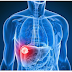 Symptoms and Causes of Liver Cancer