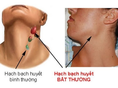 Điều trị hạch dưới hàm sưng đau thế nào?