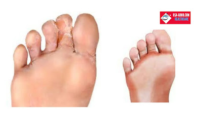 What is Athlete's foot?