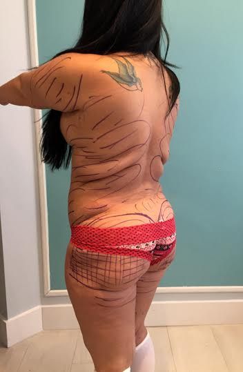 Woman has her own fat pumped into butt to get Kim Kardashian curves